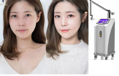 điều trị mụn laser co2